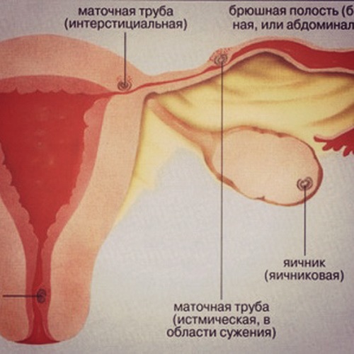 Признаки внематочной беременности на раннем сроке 5 - 6 недель