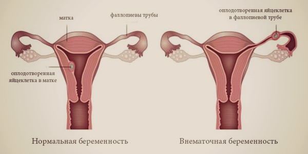 Признаки внематочной беременности на раннем сроке 5 - 6 недель